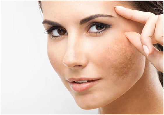 best treatment for melasma on face