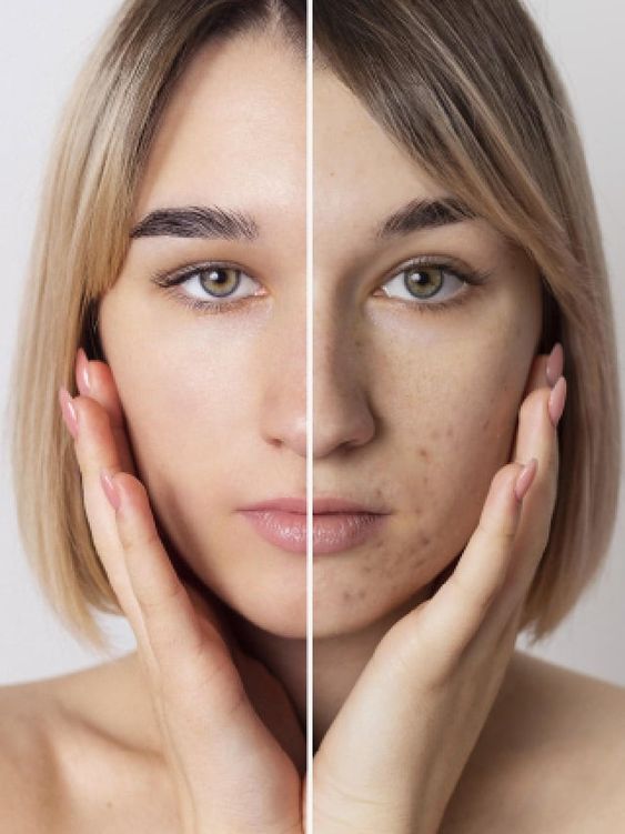 how to get rid of large pores