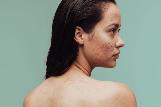 acne scar on face