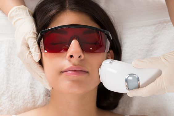 Laser resurfacing