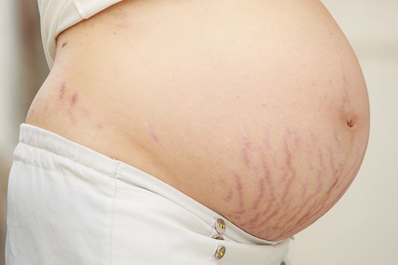 stretch mark 1
