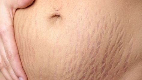 Stretch mark cream that is effective