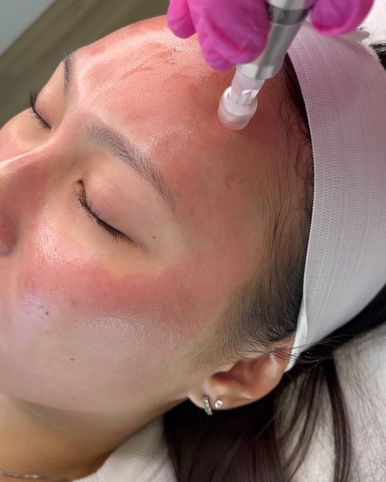 microneedling treatment